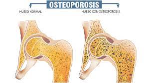 Osteoporosis, menopausia y medicina natural • El Nuevo Diario